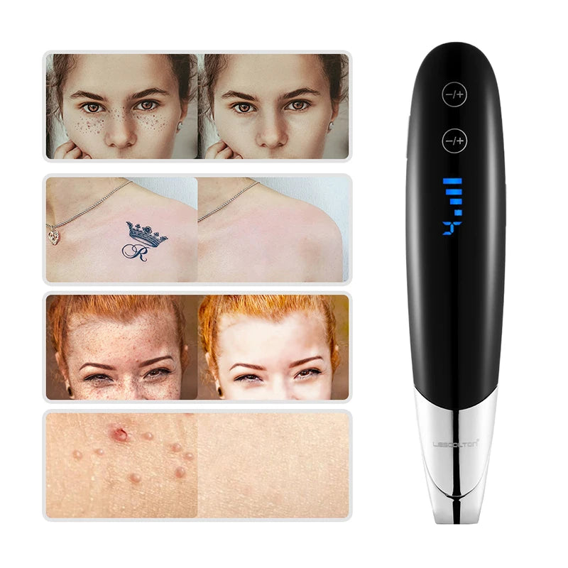 Filter Laser (scar removal laser)